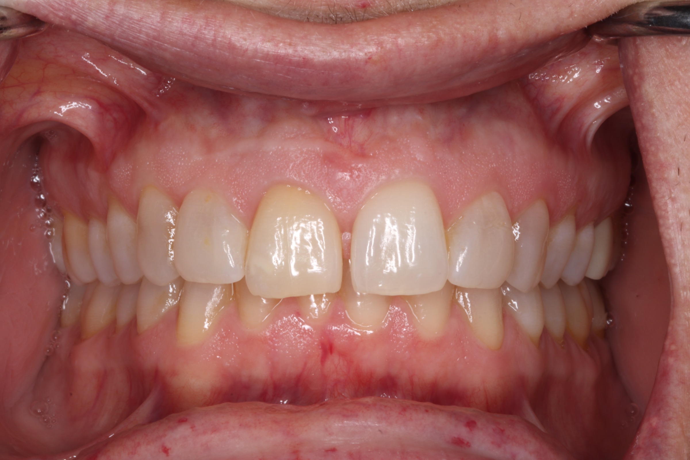 Anterior Crowns — selected portfolio study 2
