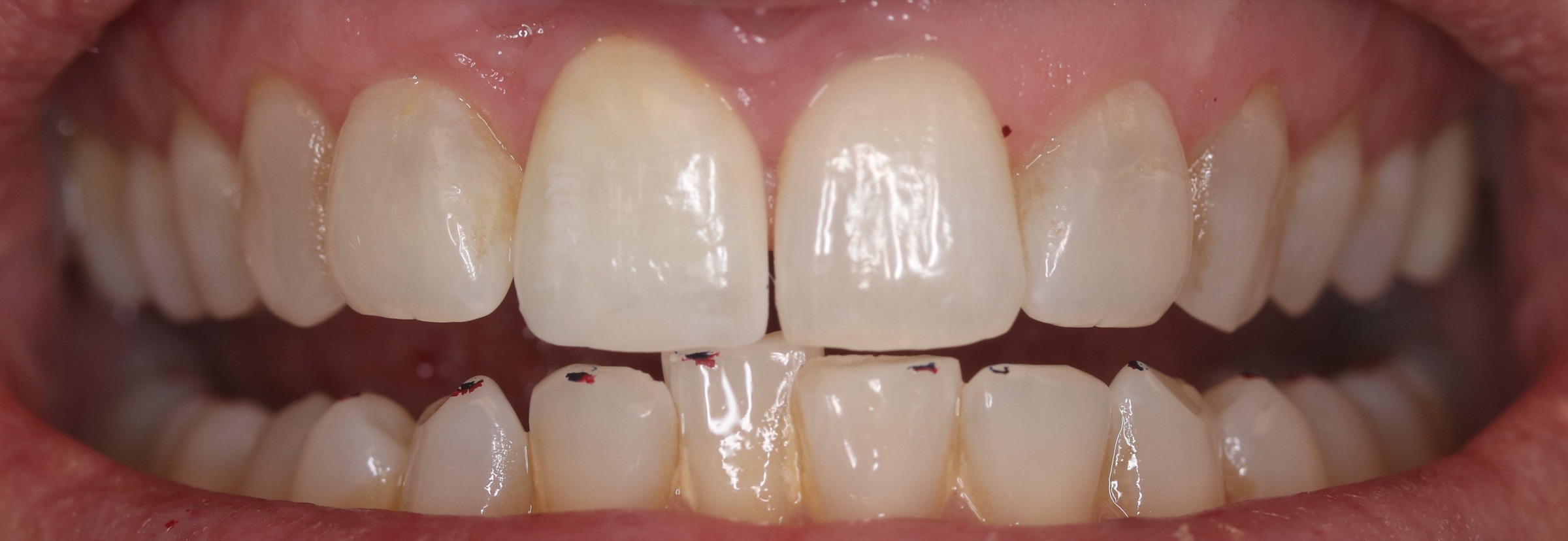 Anterior Crowns — selected portfolio study 3