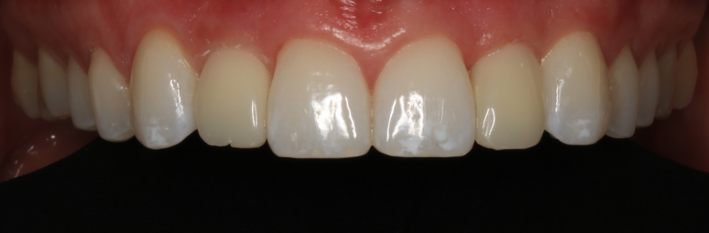 Anterior ceramic restoration portfolio study