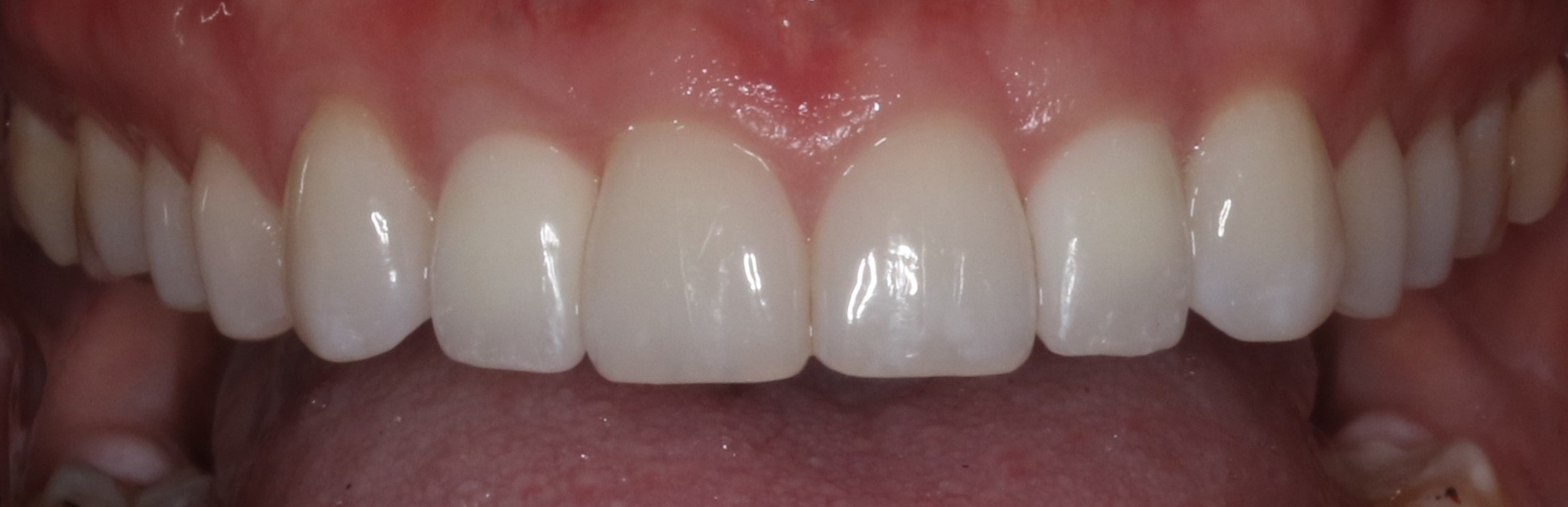 Anterior Crowns — selected portfolio study 5