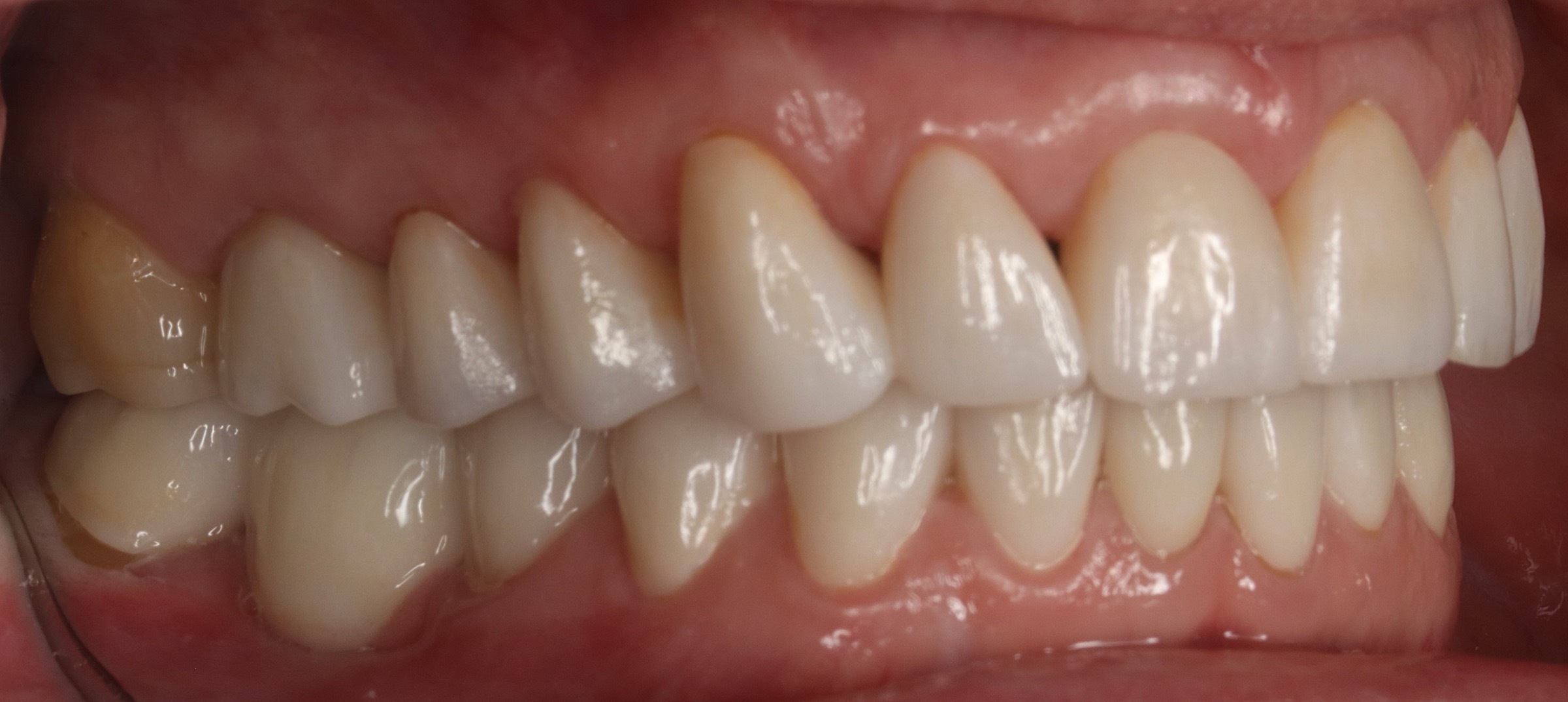 Full Restorative Crowns — selected portfolio study 1