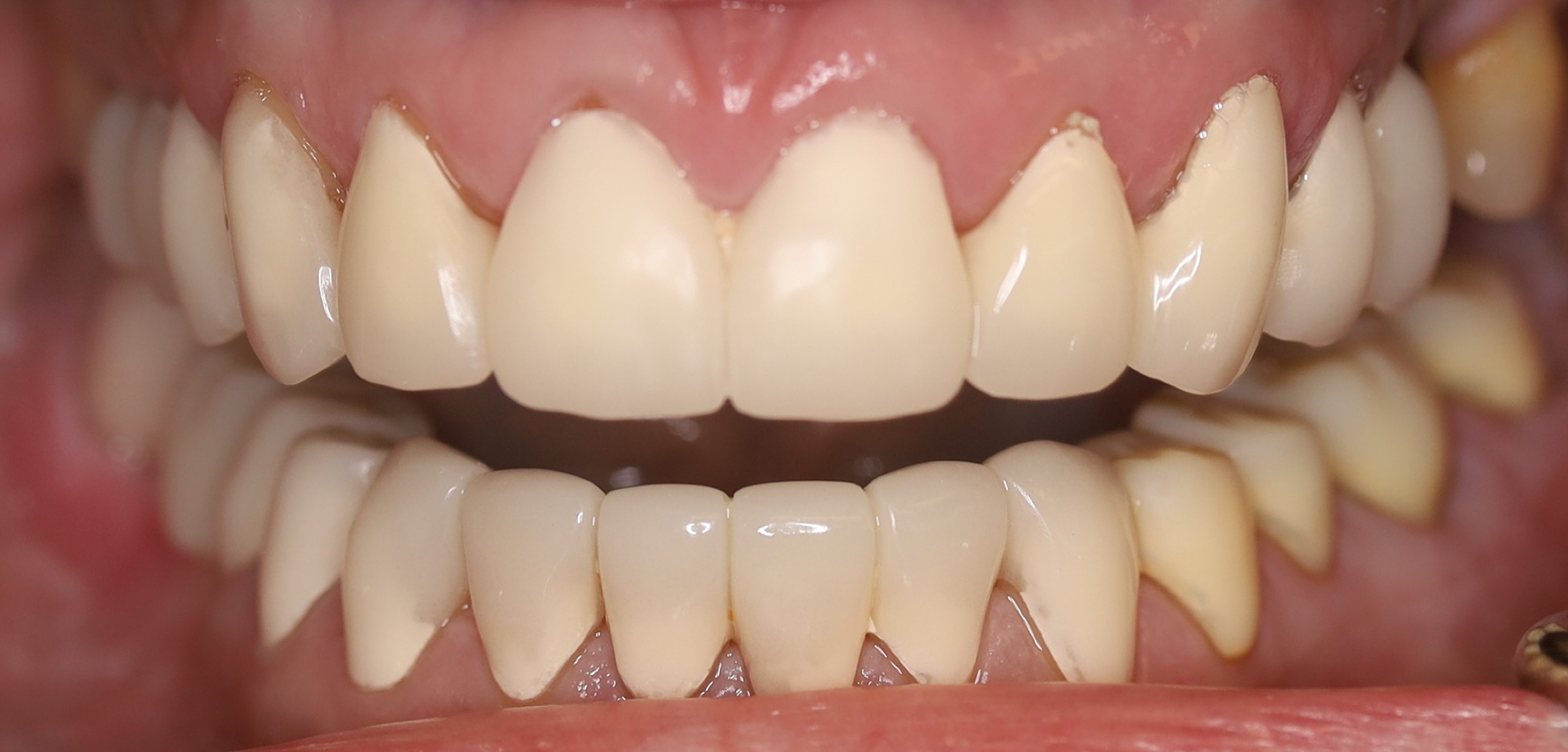 Full Restorative Crowns — selected portfolio study 2