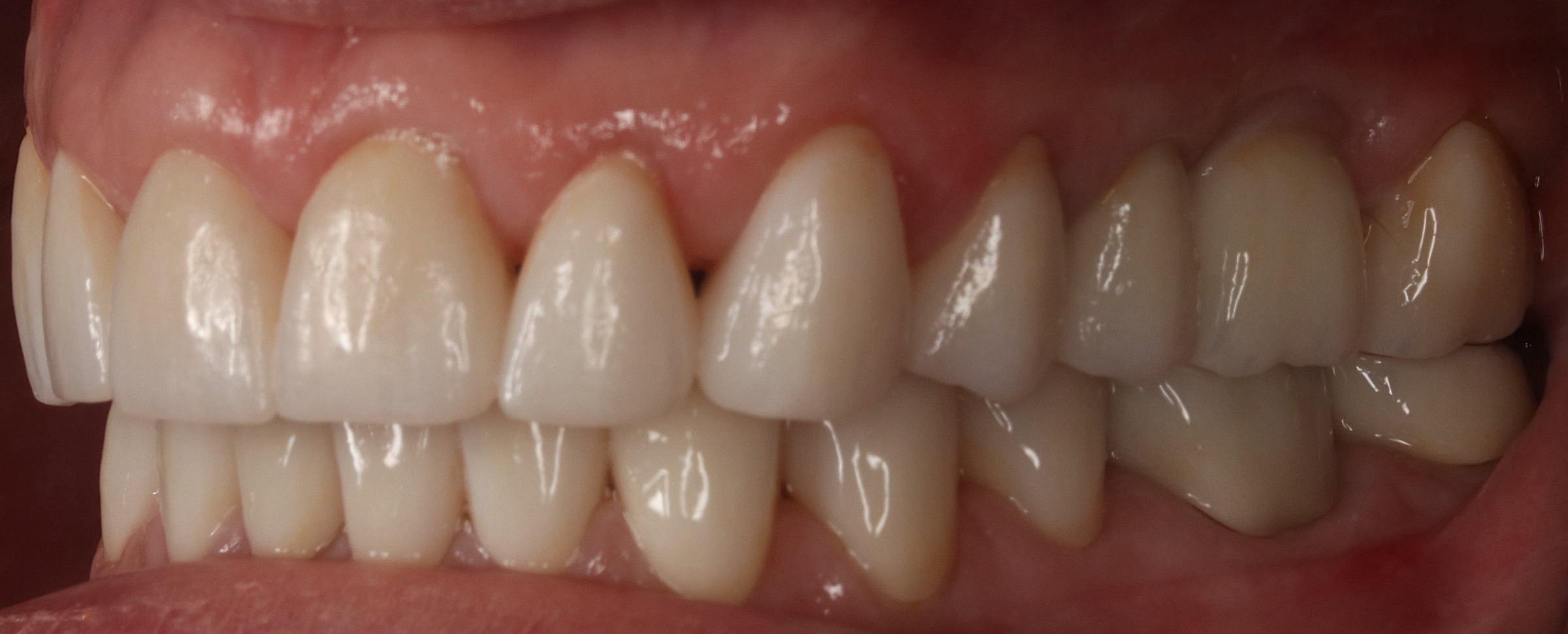 Full Restorative Crowns — selected portfolio study 4