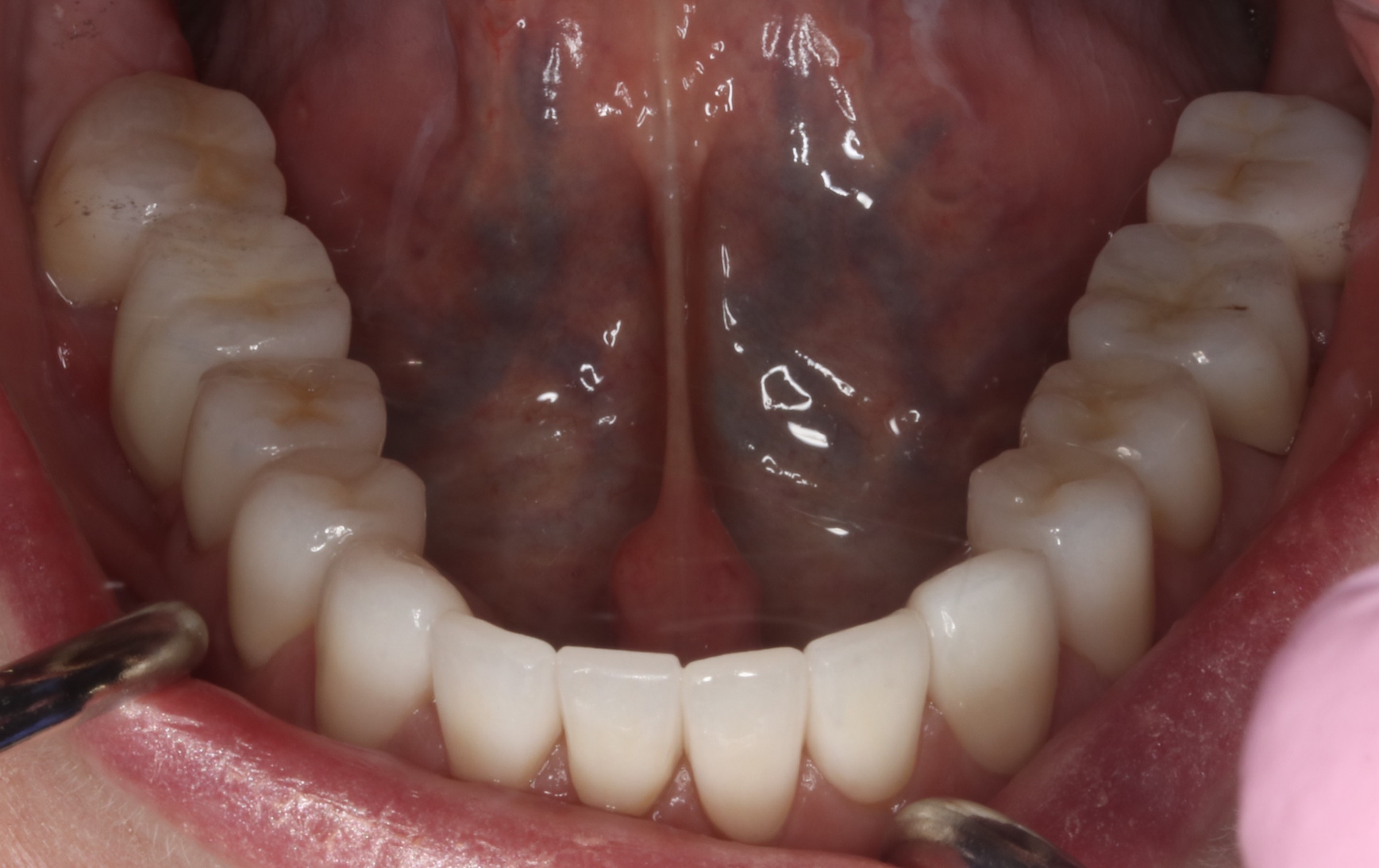 Full Restorative Crowns — selected portfolio study 5
