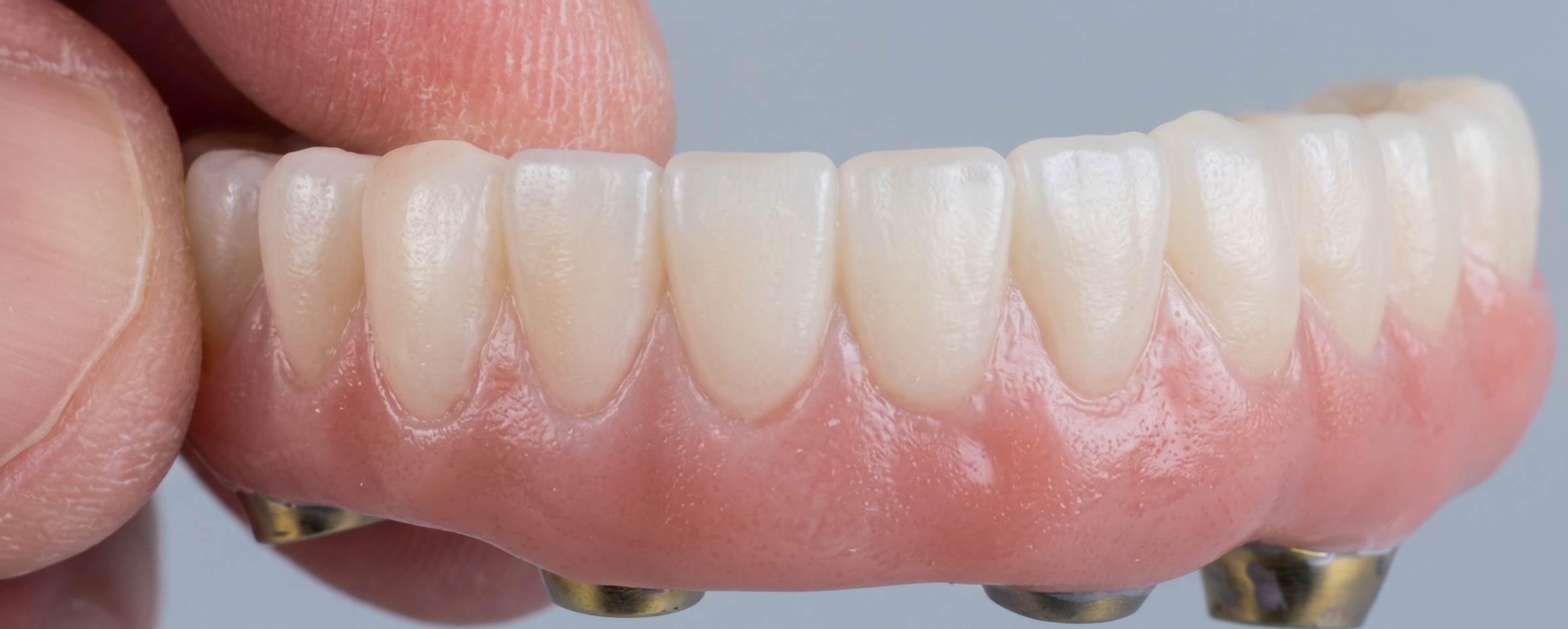 Implant-supported restoration crafted by Gyeol Dental Art Studio