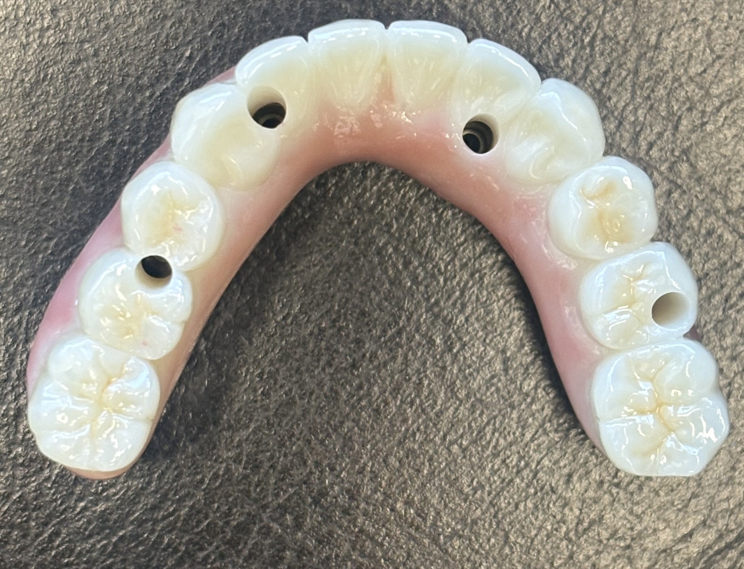 Implant Hybrid / All-on-X — selected portfolio study 4