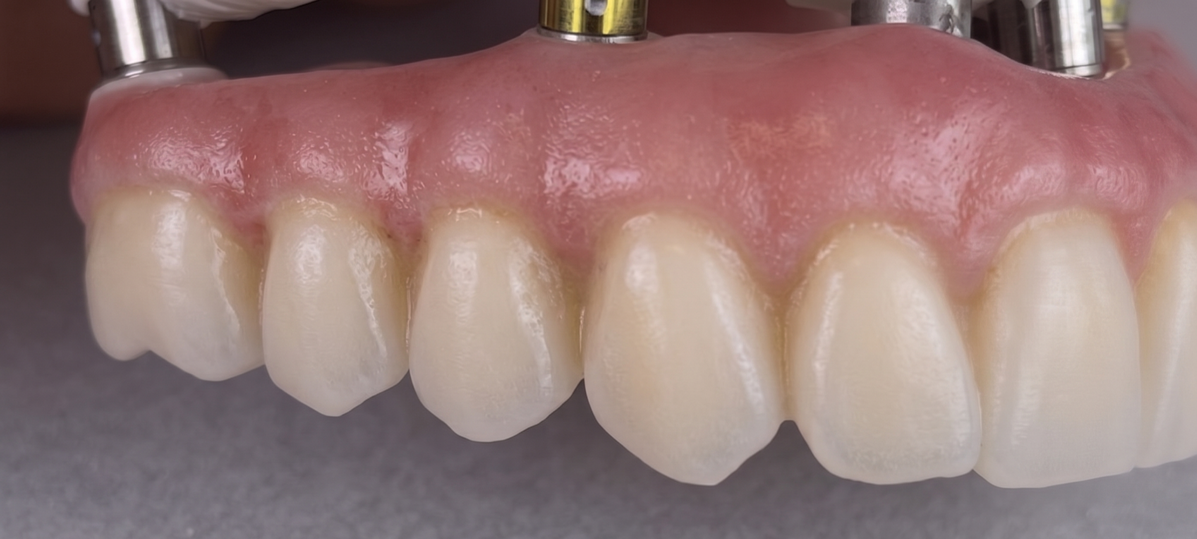 Implant hybrid restoration portfolio study