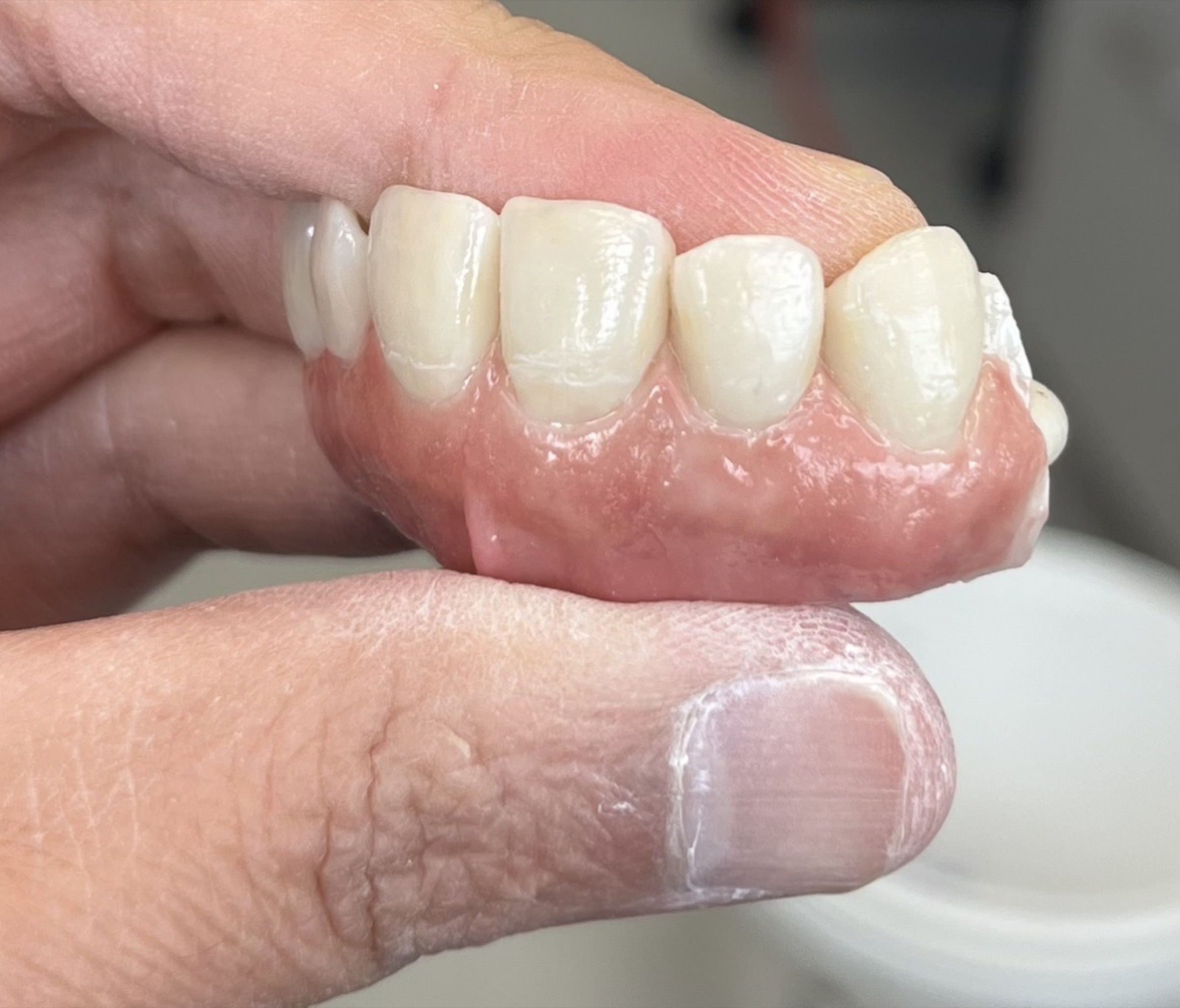 Implant Hybrid / All-on-X — selected portfolio study 8